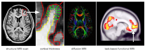 The temperature of the healthy human brain varies much more than